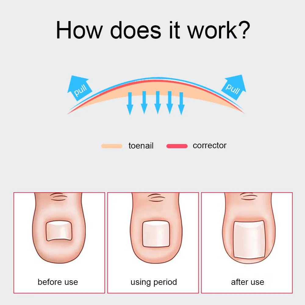 Ingrown Toenail Removal Kit 7PCS Foot Care Tool Nail Treatment Pedicure Clippers for Ingrown Toenail Lifter - petguardiansupplies