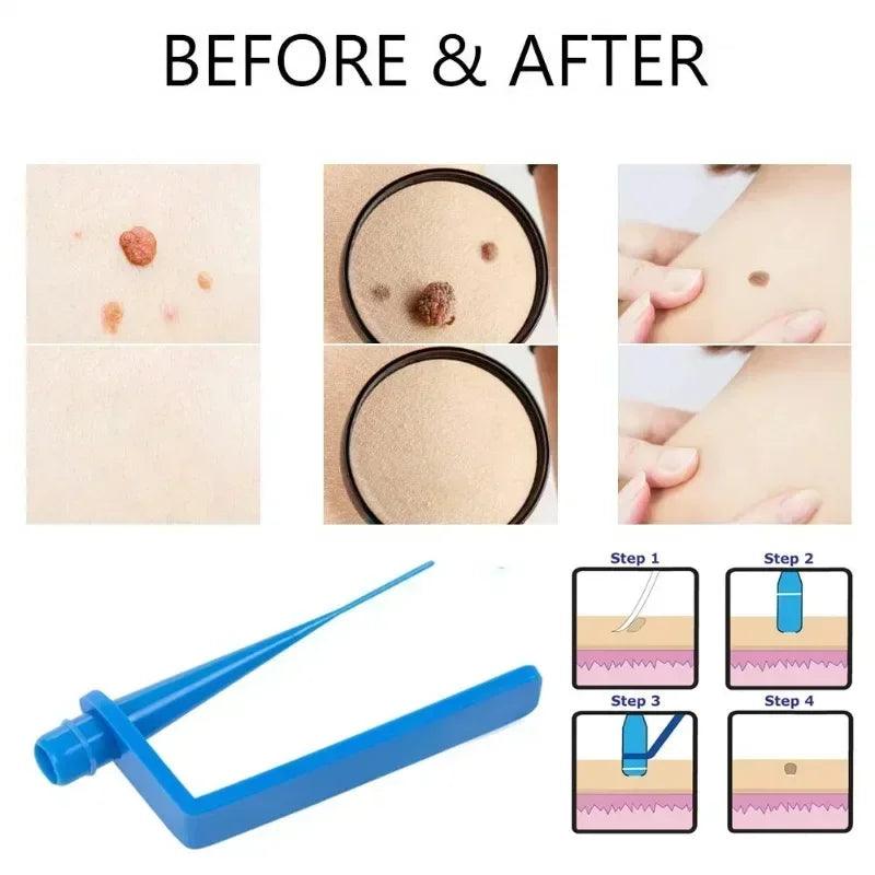 Skin Care Rubber Bands Skin Tag Remover Skin Tag Removal Kit Face Care Mole Wart Tool Skincare Beauty-health - petguardiansupplies