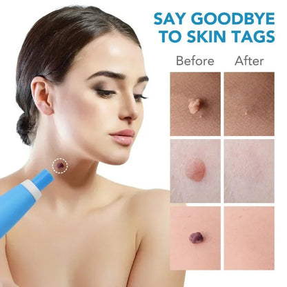 Painless Auto Skin Tag Mole Wart Removal Kit 2-in-1 Facial Body Care Treatments for Beauty Health - petguardiansupplies