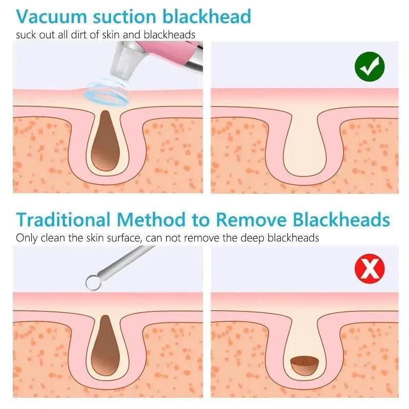 Facial Blackhead Remover Electric Acne Cleaner Device - petguardiansupplies